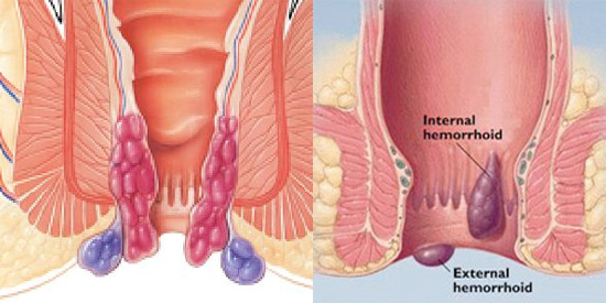 hemoroid